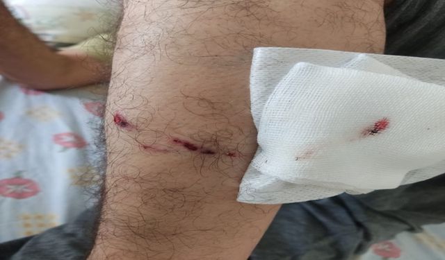 Şanlıurfa’da Sabah Sporu Kabusa Döndü: İki Kişiye Köpek Saldırısı!
