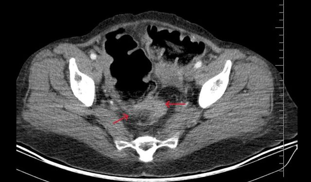 Viranşehir Devlet Hastanesi’nde Başarılı Rektum Kanseri Ameliyatı